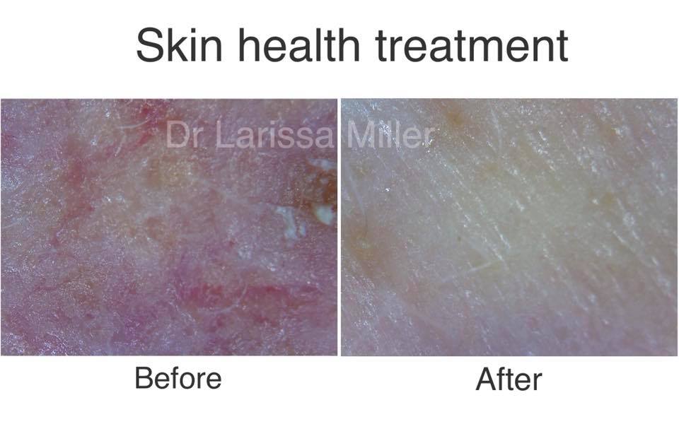 Introduction offer Skin Quality Assessment + Laser + Heallite LED + Hyaluronic Acid Application