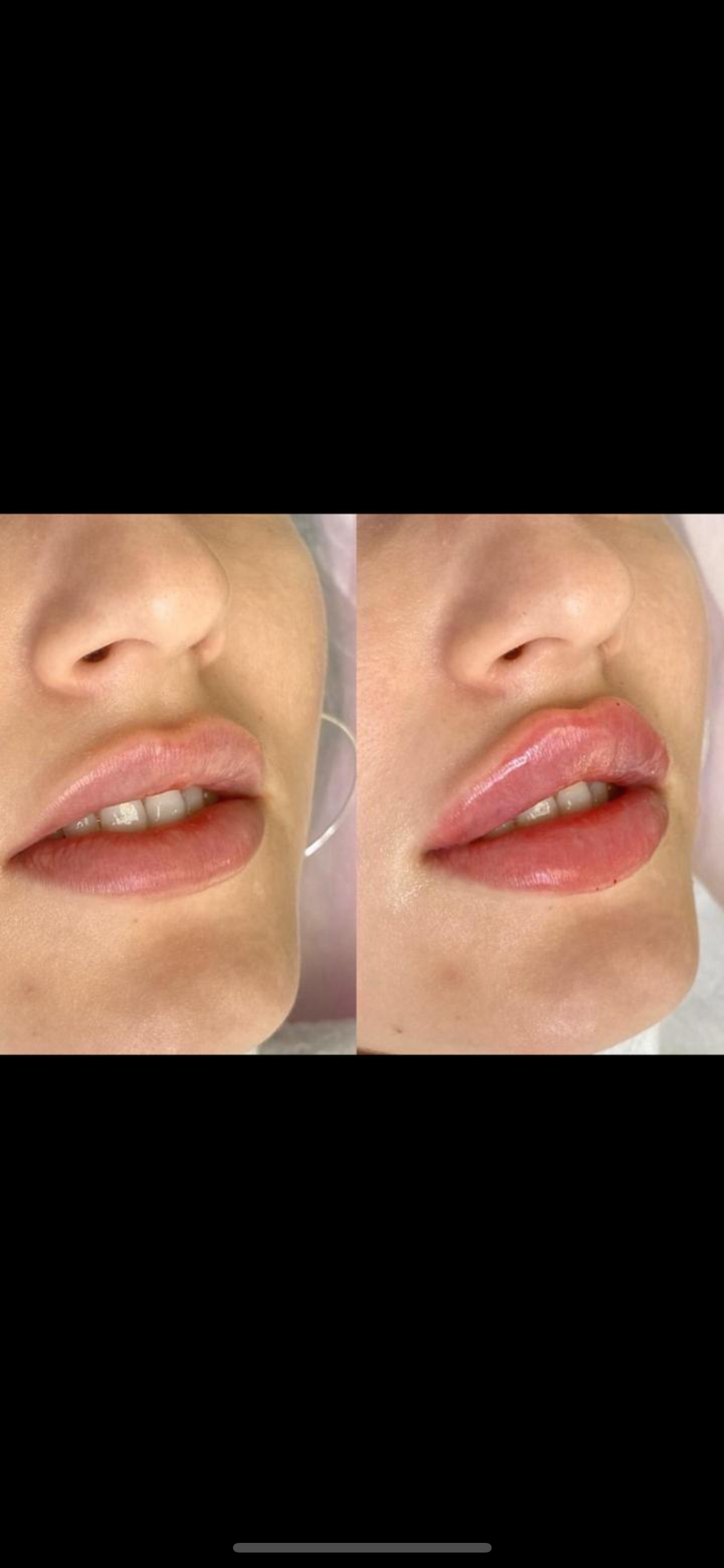 3D lip rejuvenation MODEL