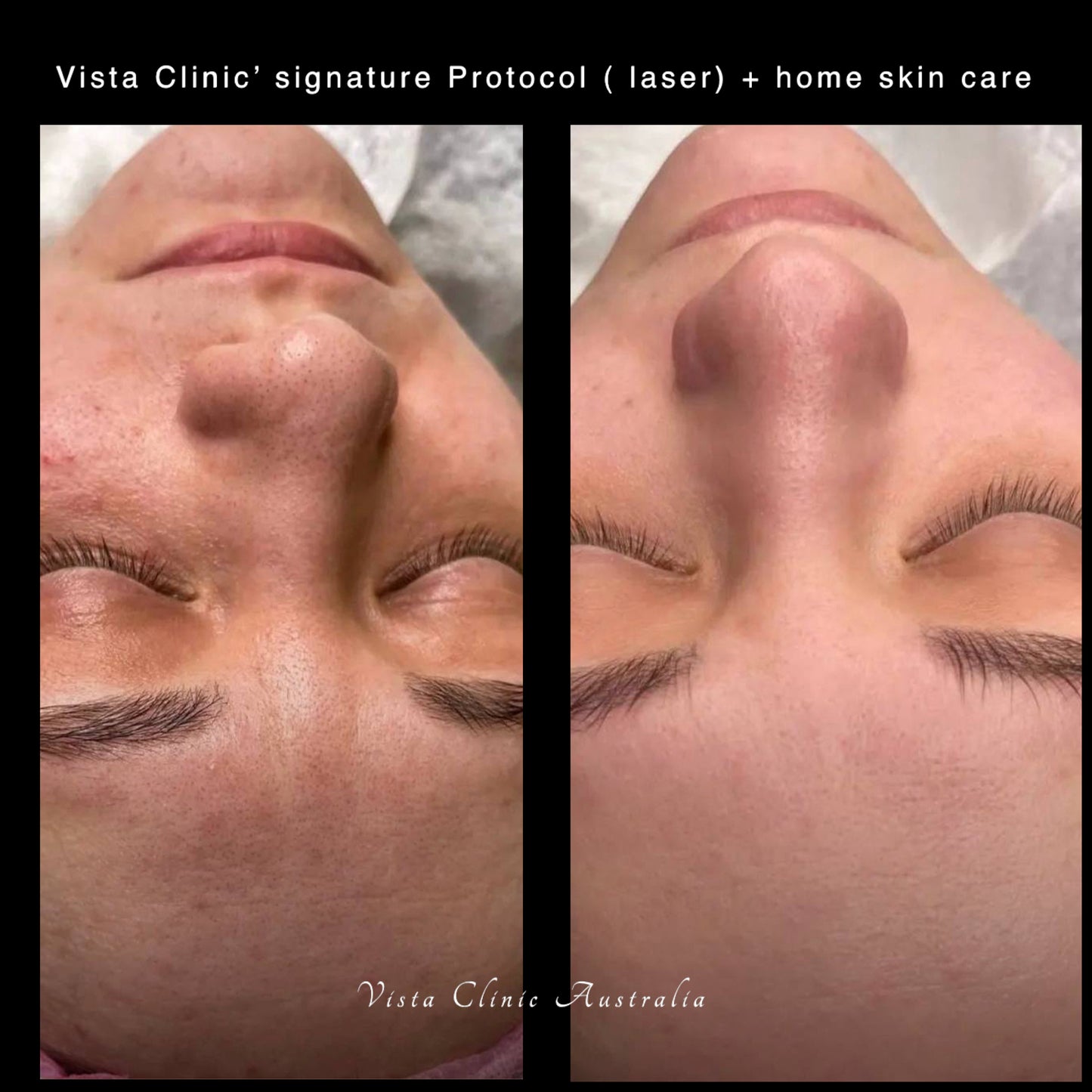 Package: 3*Vista Clinic Laser Toning and Collagen Stimulation Laser