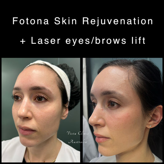 Package: 3*Fotona lunch time skin rejuvenation + 2* laser foxy eyes