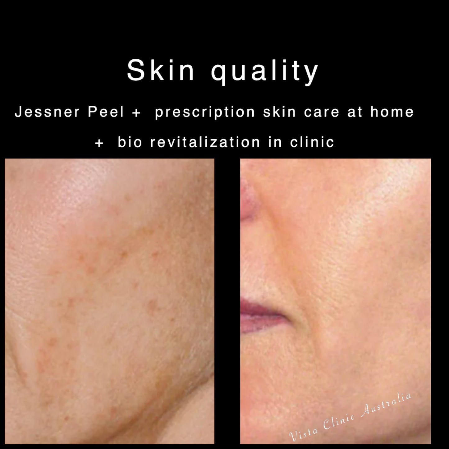 Jessner Peel - superficial strength professional peel 4 weeks supply