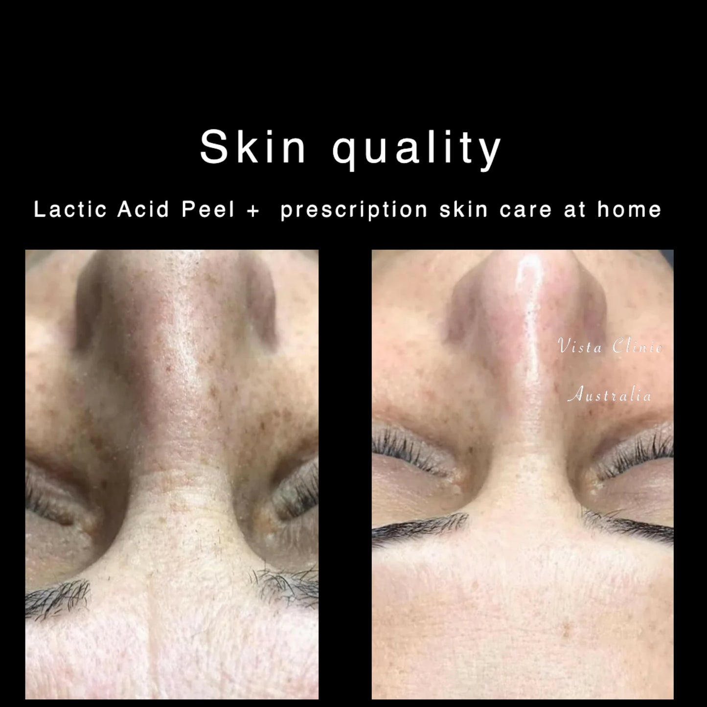 Lactic Peel - superficial strength (4 peels supply)