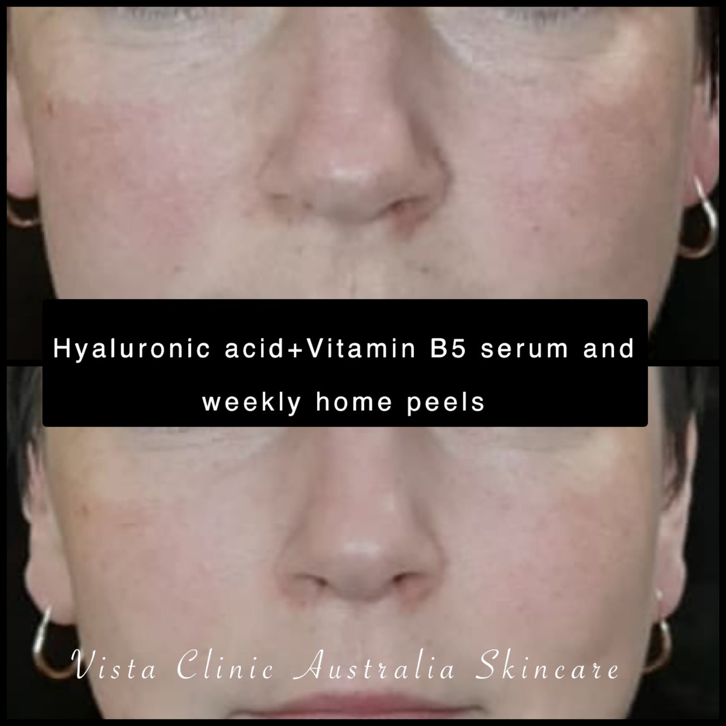 Hyaluronic Acid + Vitamin B5 Concentrate