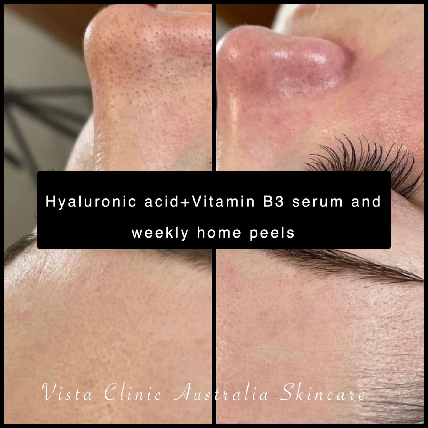 Hyaluronic Acid + Vitamin B3 Concentrate